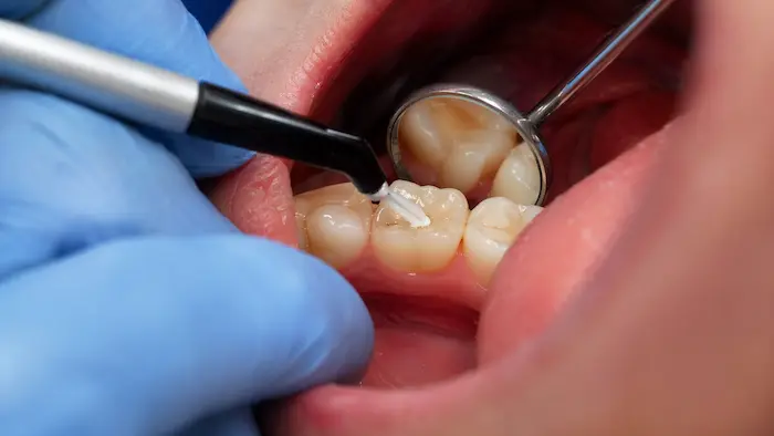 dis dolgusu nasil yapilir