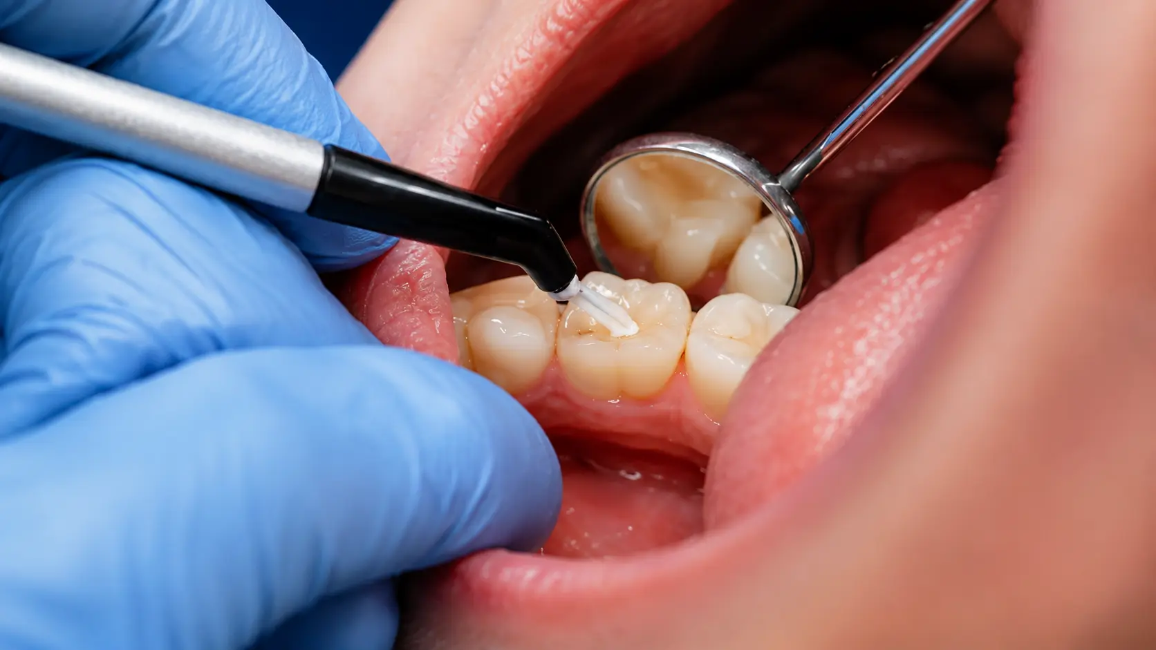 how to do a tooth filling