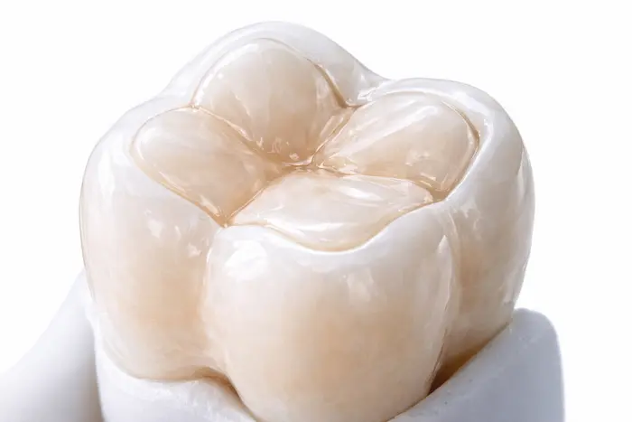 inlay dolgu avicennadis kompozit dolgu